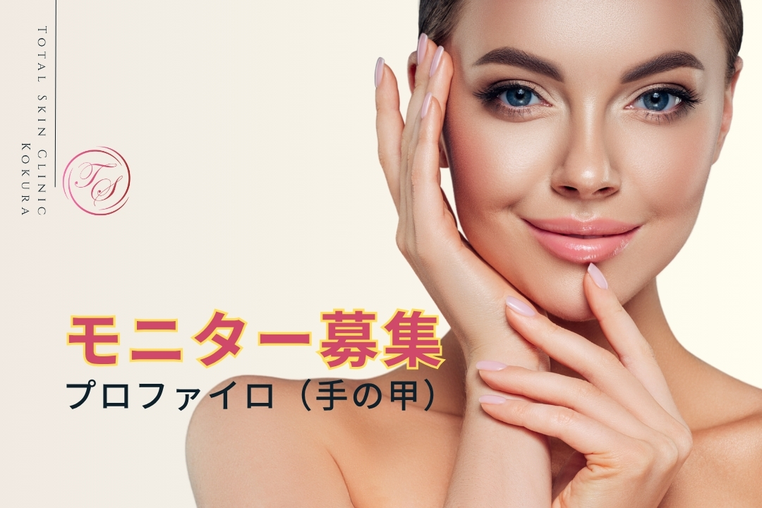 プロファイロ(手の甲)のモニター募集