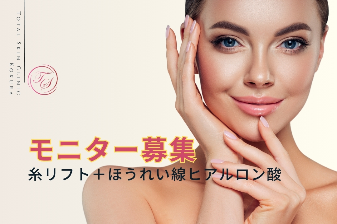 糸リフト+ヒアルロン酸(ほうれい線)のモニター募集