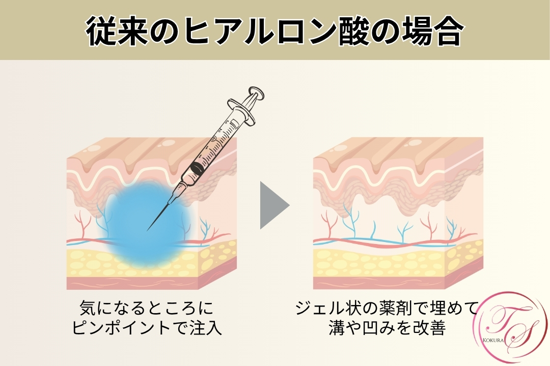 従来のヒアルロン酸の場合 気になるところにピンポイントで注入 ジェル状の薬剤で埋めて溝や凹みを改善