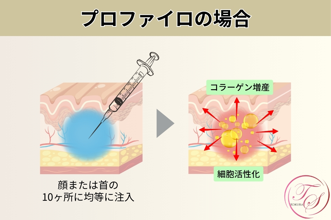 プロファイロの場合 顔または首の10ヶ所に均等に注入 コラーゲン増産 細胞活性化