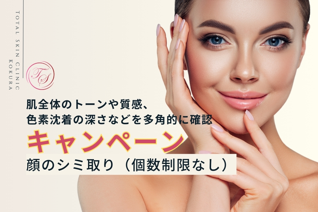 顔のシミ取り（個数制限なし）キャンペーン実施中。肌全体のトーンや質感、色素沈着の深さなどを多角的に確認