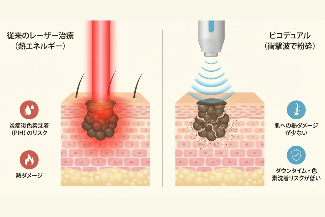 従来のレーザー治療とピコデュアルの違いを比較した断面図。左側は「従来のレーザー(熱エネルギー)」で、赤い光がメラニンを加熱し熱ダメージや色素沈着のリスクがある様子。右側は「ピコデュアル(衝撃波で粉砕)」で、青い波紋状の衝撃波がメラニンを細かく粉砕し、熱ダメージやダウンタイムのリスクを抑えている様子を描いたインフォグラフィック。