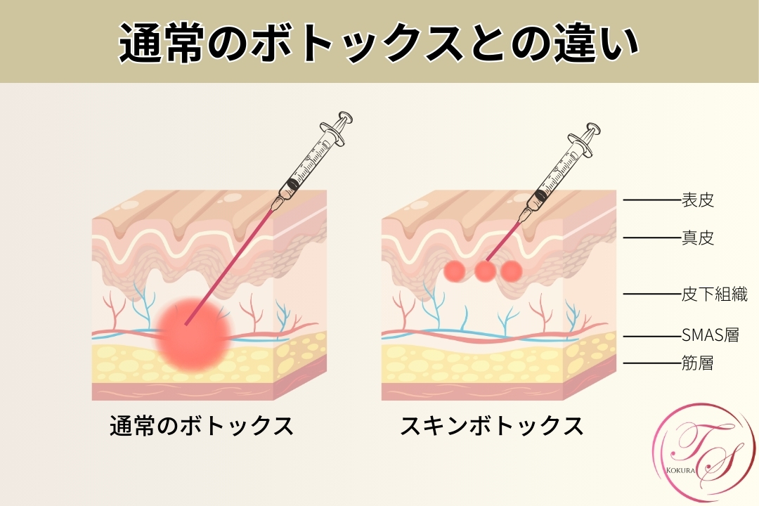 通常のボトックスとスキンボトックスの違い