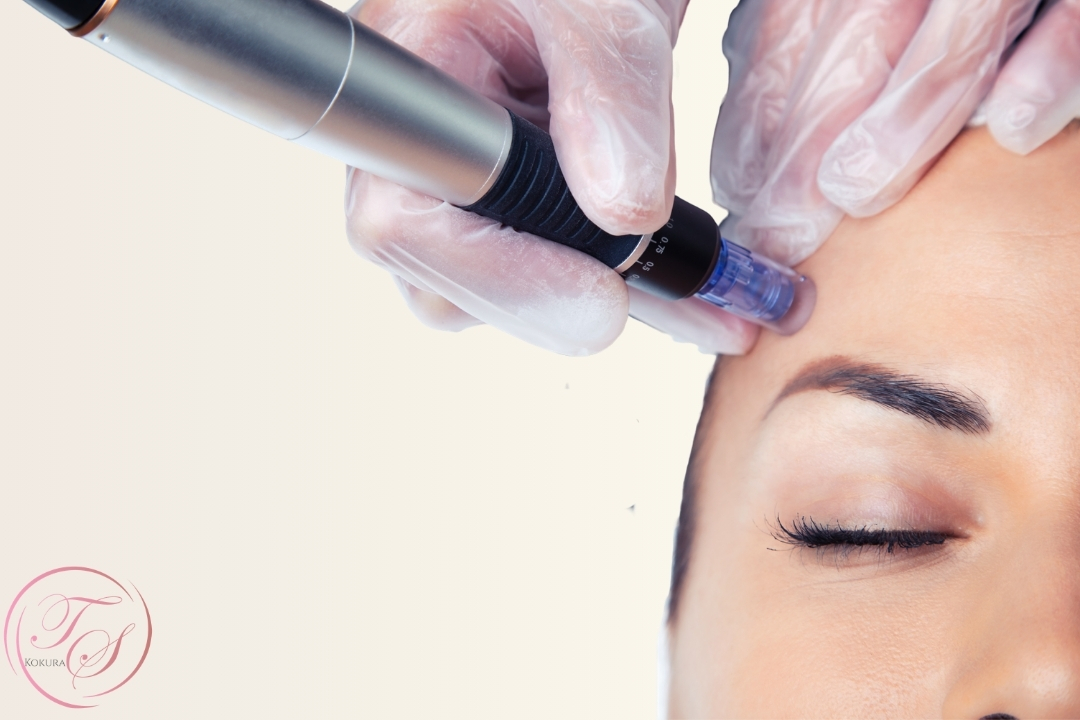 ダーマペン（dermapen）（トータルスキンクリニック小倉院）